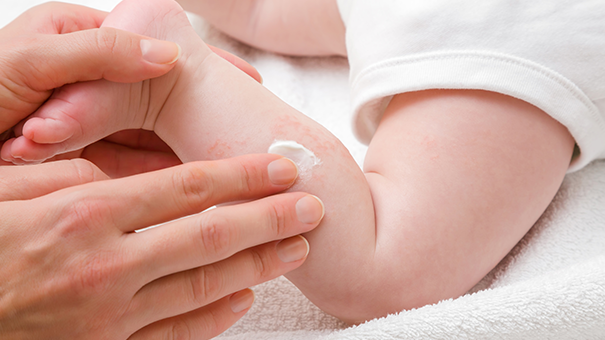 Эксфолиативный дерматит и другие поражения кожи у новорождённых