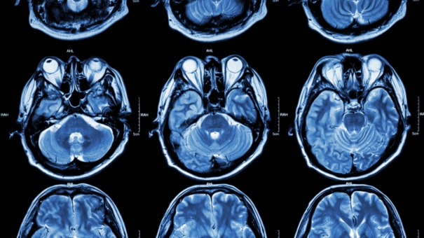 Сканирование мозга поможет предсказать, когда пациент выйдет из комы