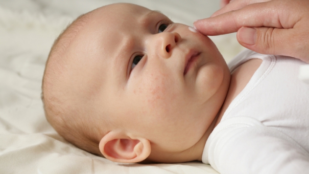 У детей, страдающих экземой или кожными инфекциями, чаще возникает пищевая аллергия