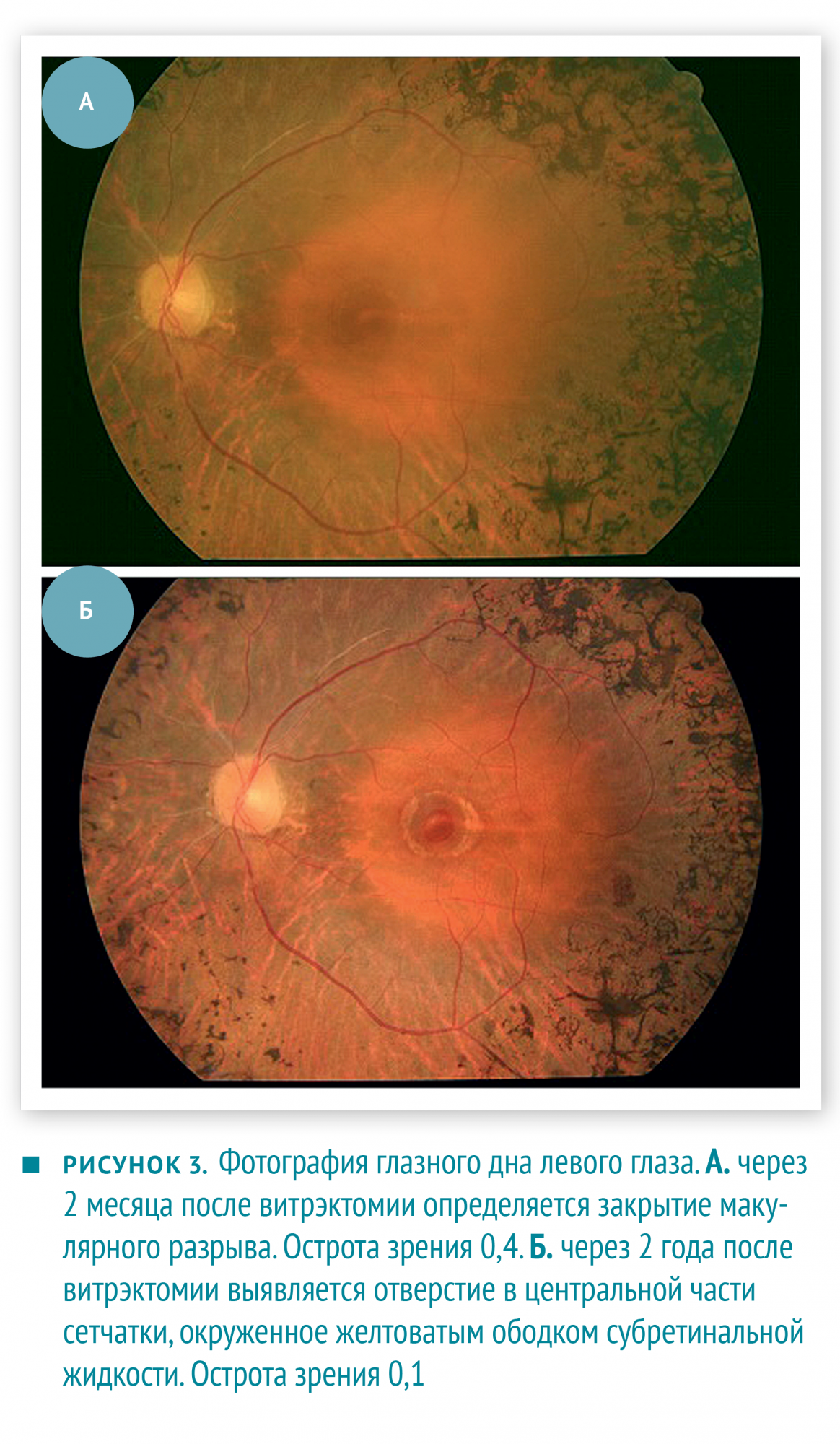 Макулярный разрыв после операции. Пигментный ретинит сетчатки. Пигментный ретинит глазное дно. Пигментная абиотрофия сетчатки. Дистрофия сетчатки глазное дно.